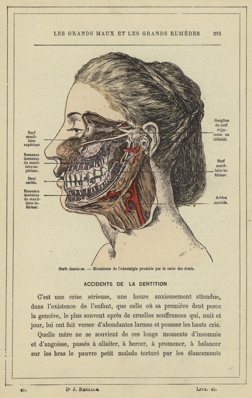 Tandnerver, Mekanisme af odontalgi fremkaldt af huller i tænderne (farve litho) af French School