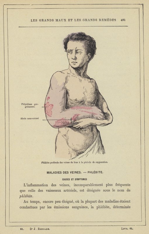 Dyb flebitis i armens vener i suppurationsperioden (farve litho) af French School