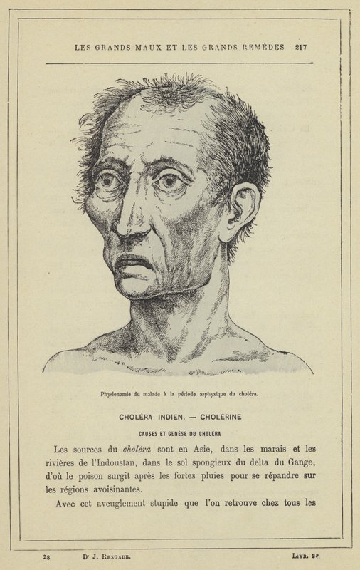 Fysiognomi af patienten under asfyksiperioden af ​​kolera (farve litho) af French School
