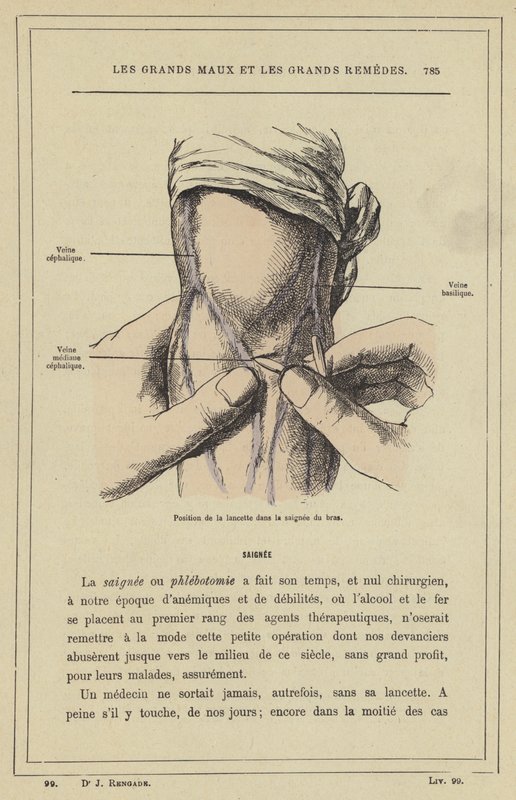 Placering af lancetten i armblødningen (farve litho) af French School