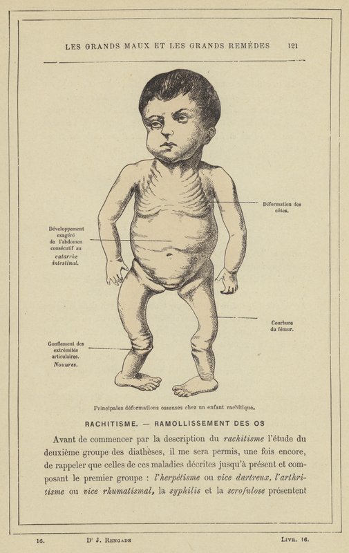 Vigtigste knogledeformationer hos et barn med rakitis (farve litho) af French School