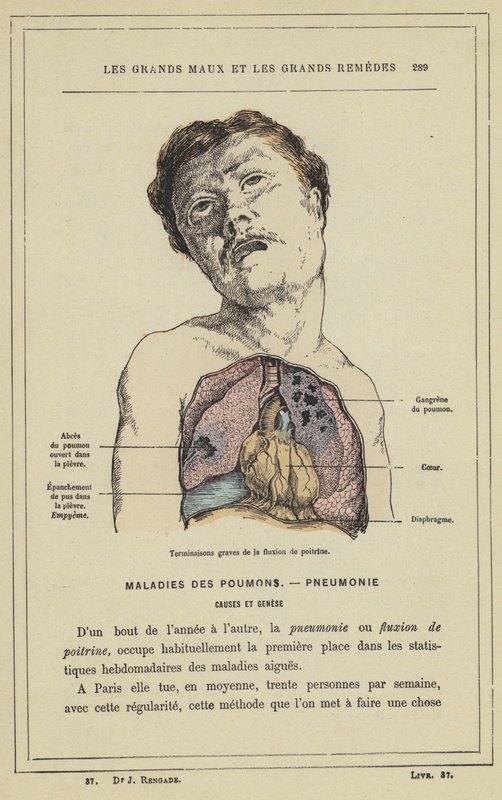 Alvorlige afslutninger af brystfluxion (farve litho) af French School