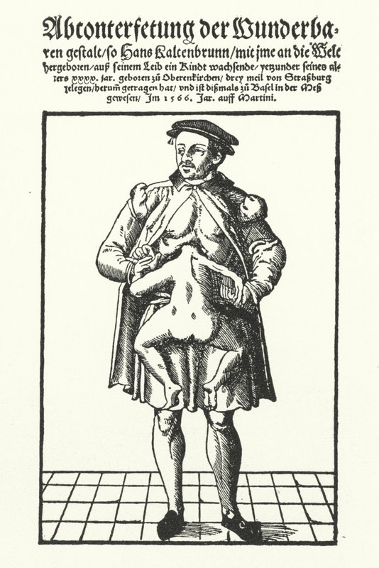 Hans Kaltenbrunn og hans uudviklede sammenføjede tvilling (gravering) af German School