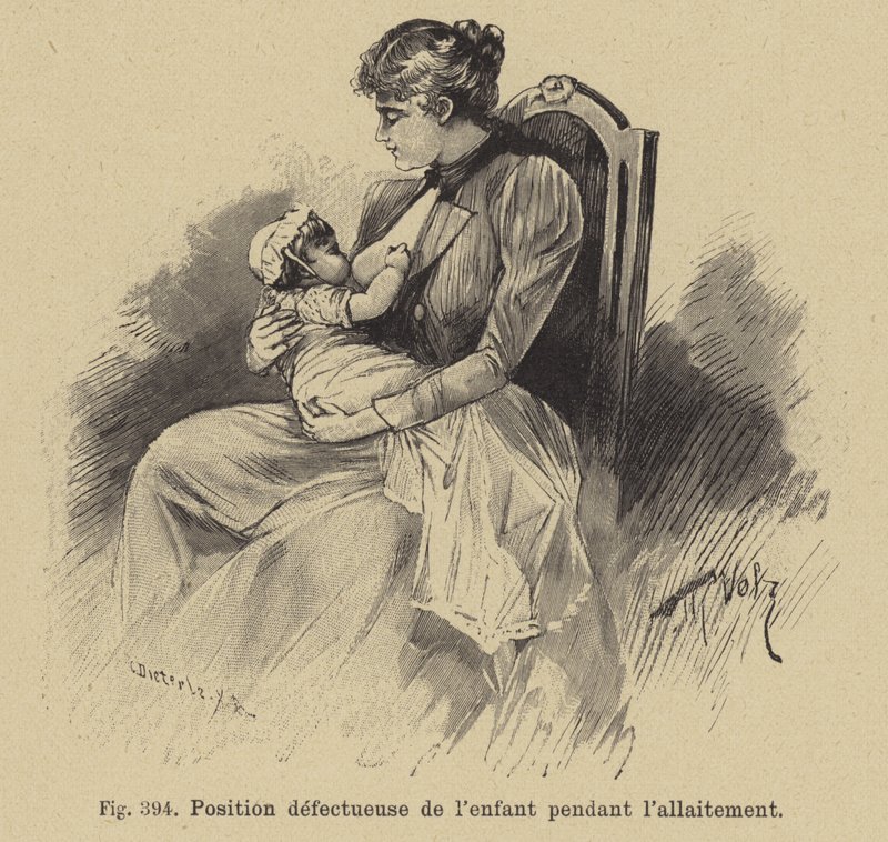 Forkert position af en baby under amning af German School