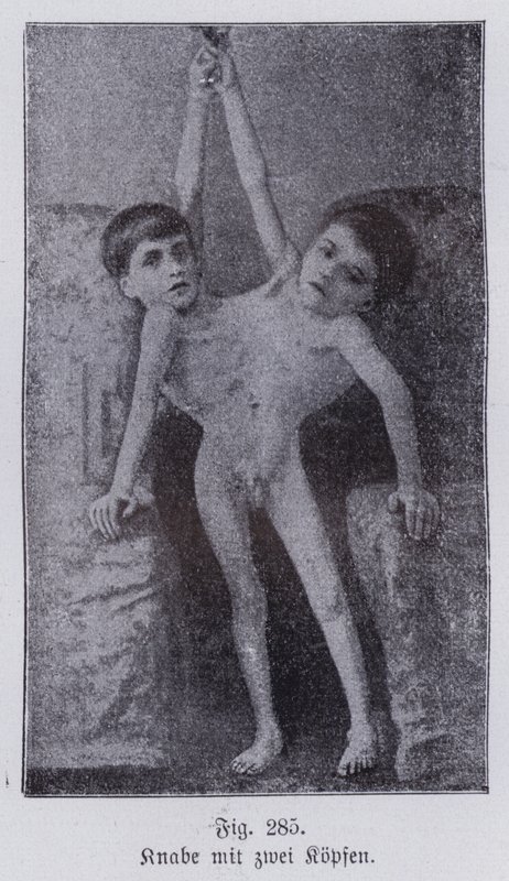 Giacomo og Giovanni Battista Tocci, italienske sammenføjede tvillinger (s/h-billede) af Italian Photographer