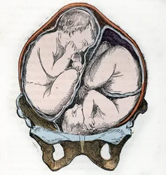 Fremstilling af to fostres gode position under en tvillingegraviditet, stik fra «La nature et l