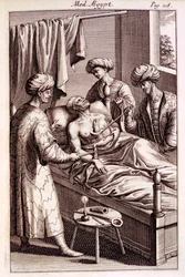 Illustration af moxibustion fra Medicina Aegyptorum af Prospero Alpinus, 1745