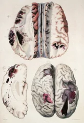 Kapillær apopleksi, fra "Anatomie Pathologique du Corps Humain" af Jean Cruveilhier (1791-1874) 1828-42 (farvestik)