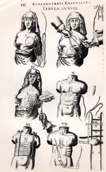 Operation for brystkræft, fra Armamentarii Chirurgici af Johannes Schultes (1595-1645), udgivet i Amsterdam, 1672