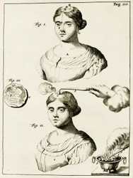 Behandling af en epilepsipatient, fra Øvelser i Lægekunst af Frederik Dekkers, 1694