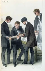 Amputering af en arm, fra en medicinsk manual af Jean-Baptiste-Leon Dubreuil, ca. 1850-60