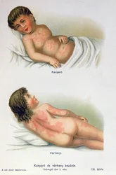 Mæslinger og skarlagensfeber, fra en familielægebog, ca. 1900