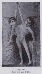 Giacomo og Giovanni Battista Tocci, italienske sammenføjede tvillinger (s/h-billede)