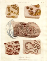 Patologiske hudforandringer: Forskellige former for psoriasis