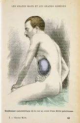 Typisk forstørret milt hos en malariapatient, ca. 1890