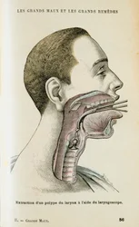 Brug af et laryngoskop til at hjælpe med at fjerne en polyp fra halsen, c1890