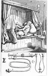 Clystère (til lavementer) af Johannes Sculptetus "" Armamentarium Surgical"". Venedig 1665