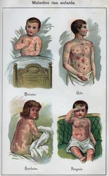 Sygdomme hos børn: Nældefeber, mæslinger, fnat, skarlagensfeber. I "Den nye naturlige medicin"" af F.E. Bilz.