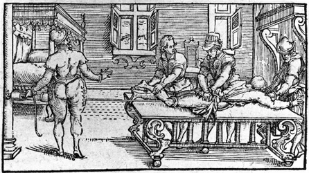 Reduktion af en dislokation, -i "Medical Treatise" af Ambroise Paré, omkring 1560.